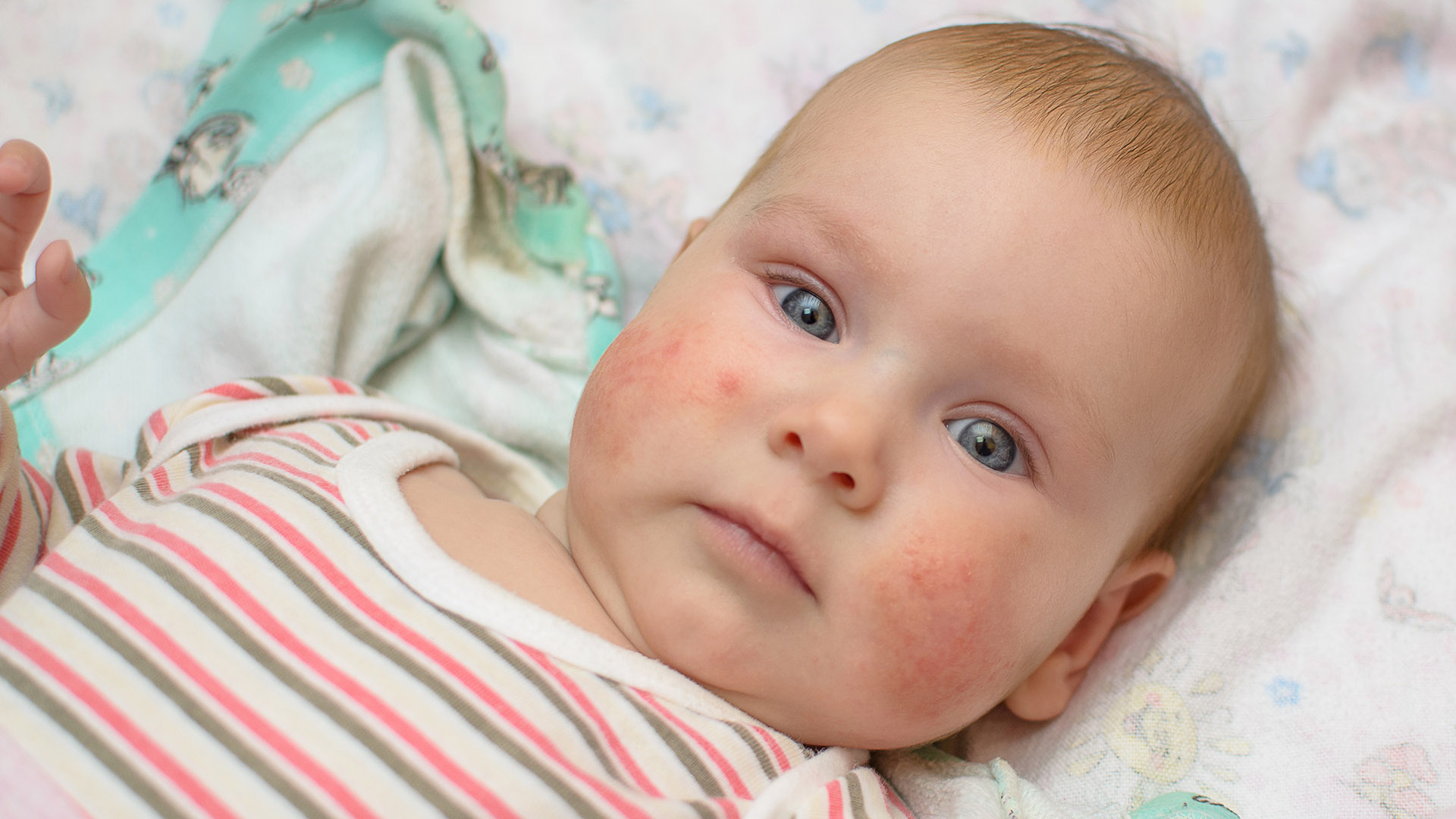 Как лечить дерматит у грудного ребенка